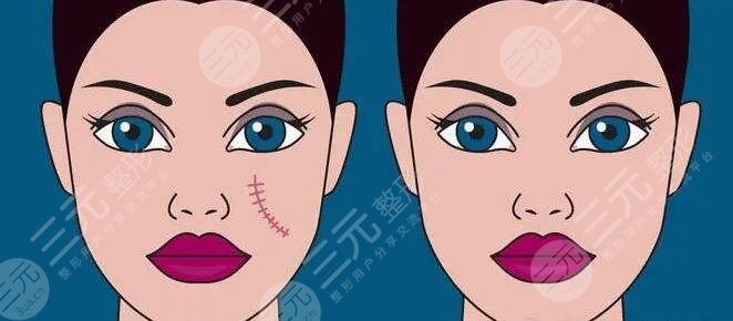 脸部伤疤整形要多少钱费用报价，疤痕修复的方式都有哪些？你适合哪种？