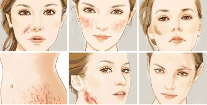 脸部伤疤整形要多少钱?