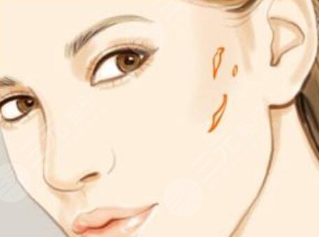 脸部伤疤整形术后注意事项