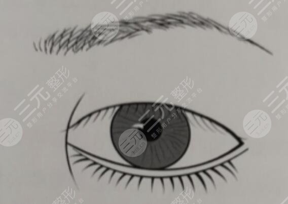 开眼角手术