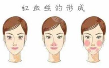 激光美容