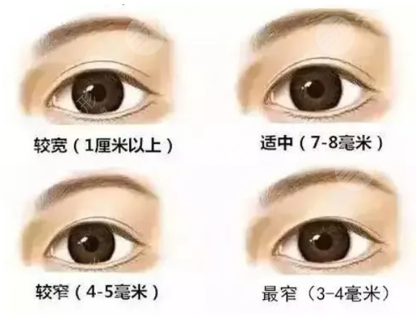 龙岗中心医院王传家双眼皮案例分享：