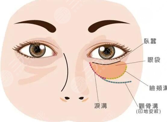北京祛眼袋手术费用要多少？本地口碑医院排名：薇琳、艺星实力展现~