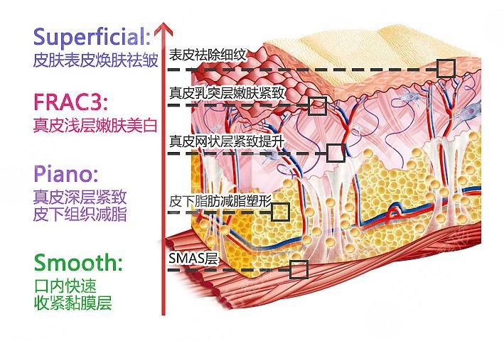 fotona4D全脸多少钱？fotona4D有什么功？价格收费参考_注意事项get~
