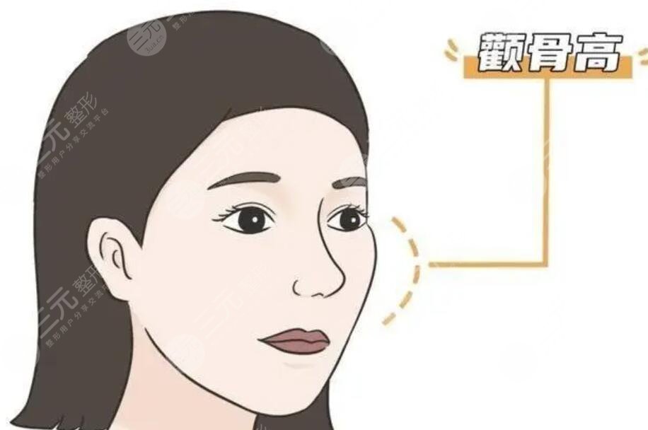 削颧骨手术大概需要多少钱?