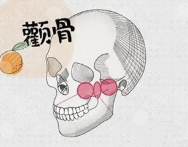 削颧骨手术大概需要多少钱?