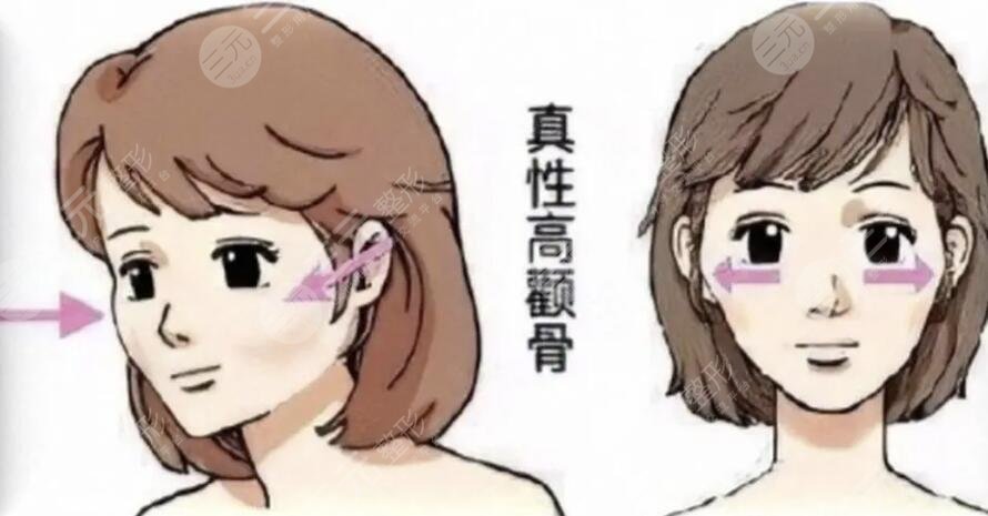 削颧骨注意事项