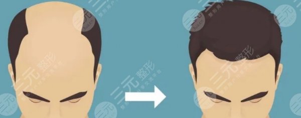 天津植发价格多少钱左右？2025价目表公开！术前防坑指南分享~