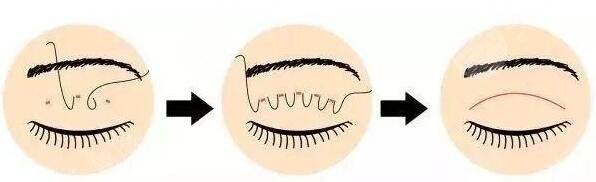 上海九院割双眼皮多少钱?