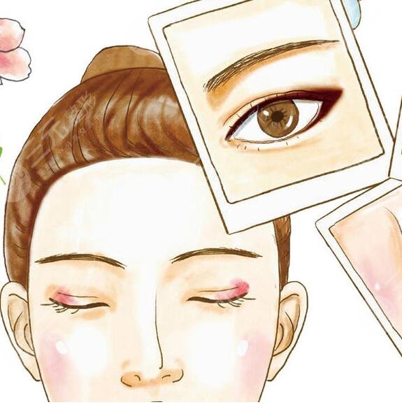 上海九院割双眼皮性价比