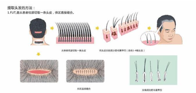 头发种植真的可以完成脱落吗?
