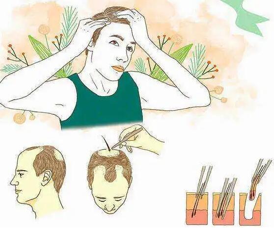 头发种植手术为什么不能提取别人的毛囊?