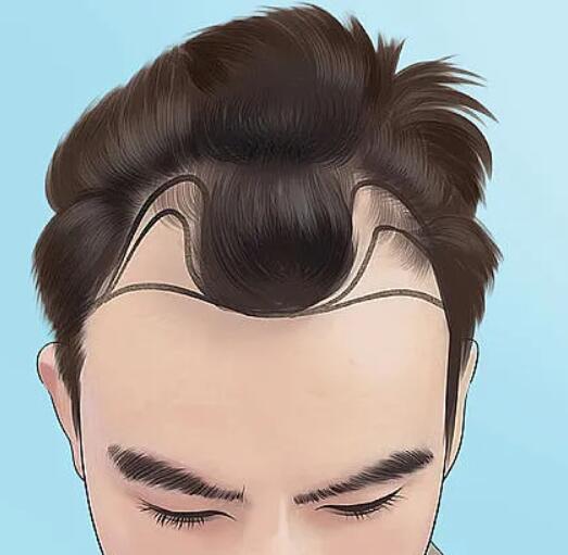 发际线种植能保持几年时间呢