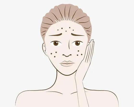 北京大学第一医院整形外科激光祛斑案例分享