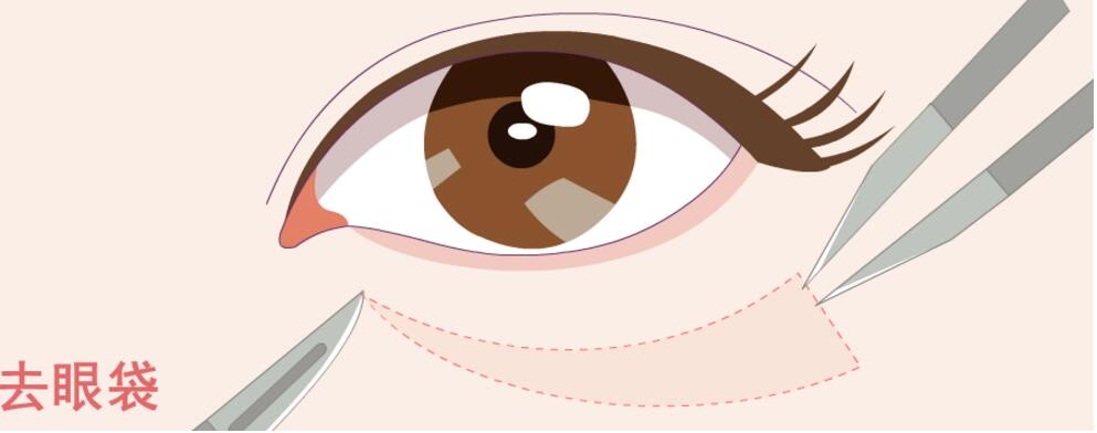 西京医院刘恒鑫医生去眼袋案例