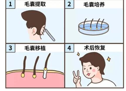 中山三院植发技术介绍