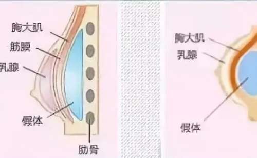 无锡隆胸修复哪家好？前十排行榜单曝光！