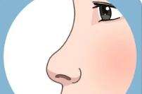隆鼻170.jpg