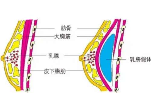 中山做隆胸技术较好的医院！2025排行更新