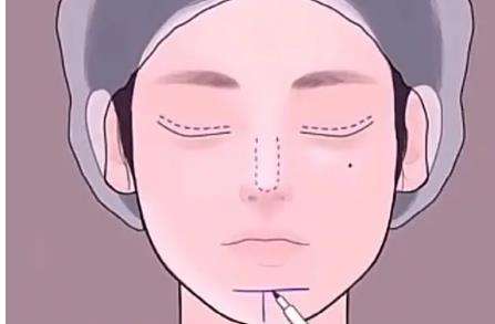 隆鼻115.jpg