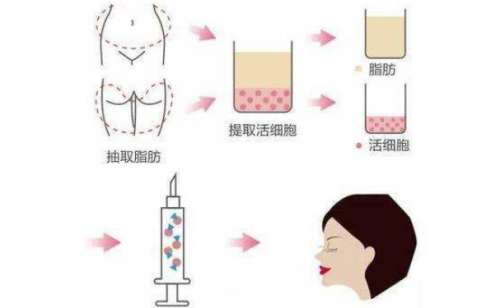 武汉三甲脂肪填充医院排名,技术特点介绍